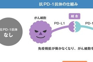 「腎がん」に有効な新免疫療法が登場　日本でも患者テストが進みつつある