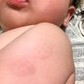子どもの予防接種「義務」ではないが...　感染すると治療法なく重症化の危険