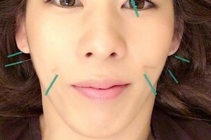 吉田沙保里の女子力アップが加速　「美容鍼灸」でハリまみれ顔を公開