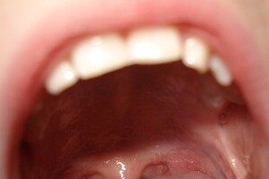 アクシデントで歯がポロリ抜けた　保管次第で使えるようになるかも