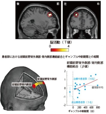 (上) ギャンブル依存症患者の場合は背外側前頭前野の活動が低下していることが示された
(下) 背外側前頭前野と内側前頭前野の結合が弱い患者ほど、ギャンブルを絶っている期間が短く、また、低ノルマ条件でハイリスク・ハイリターンのギャンブルを選択する傾向が強いことがわかった
