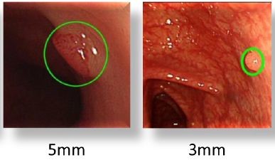 ポリープ検出の例（国立がん研究センターの発表資料より）