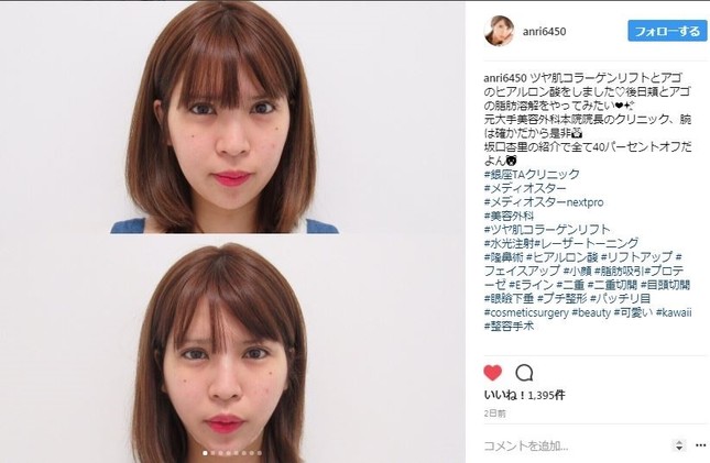 上が整形前、下が整形後（坂口さんのインスタグラムより）