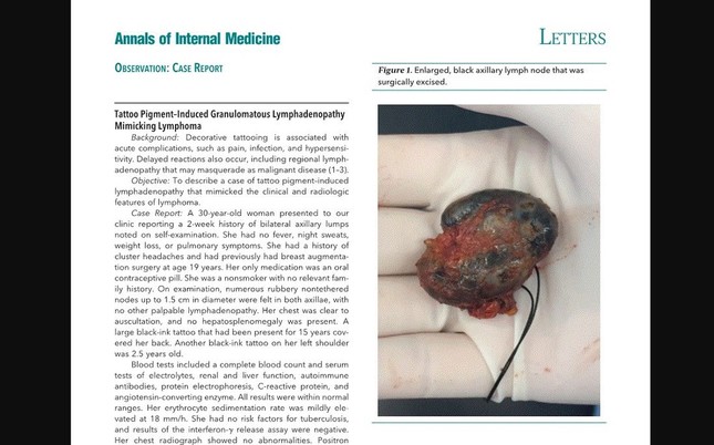 リンパ節がインクで真っ黒に（画像は論文掲載誌の一部より）
