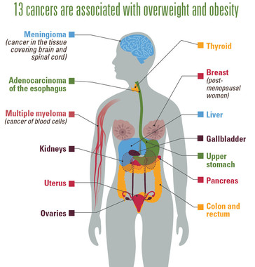 肥満が発症に関係する13種類のがん（米疾病対策センターの「Vital Signs」より）
