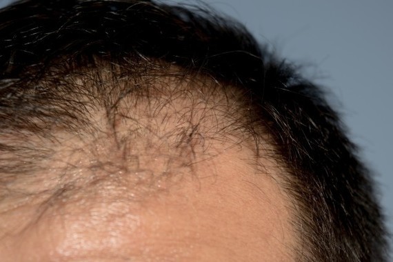 ハゲに忖度？（画像はイメージ）
