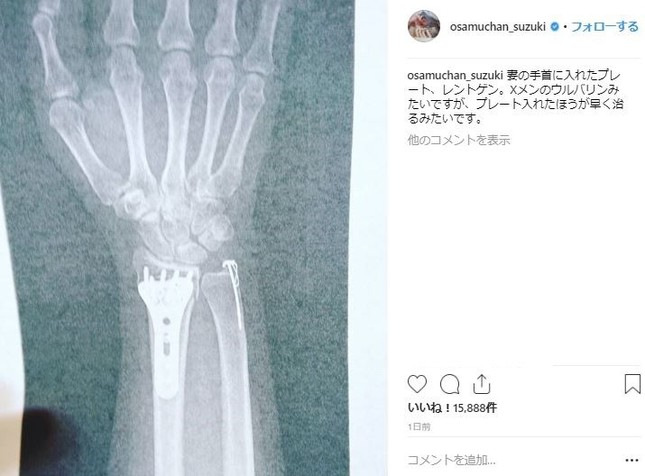 大島さんの右手首のレントゲン写真（鈴木さんのインスタグラムより）