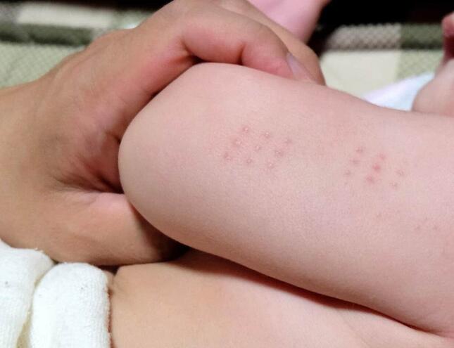 ハンコ注射の跡（画像はイメージ）