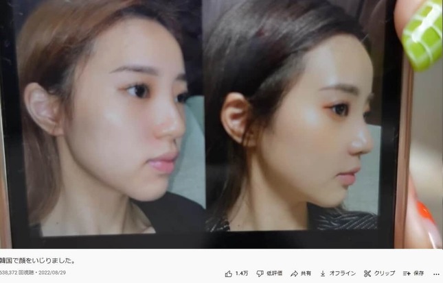 21歳人気女性YouTuberが韓国で整形 「めっちゃ顔が幼くなった」驚きのビフォーアフター公開: J-CAST ニュース【全文表示】