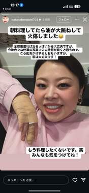 やけどで「もう料理したくないです。笑」と渡辺直美さん。写真は渡辺さんのインスタストーリーズから