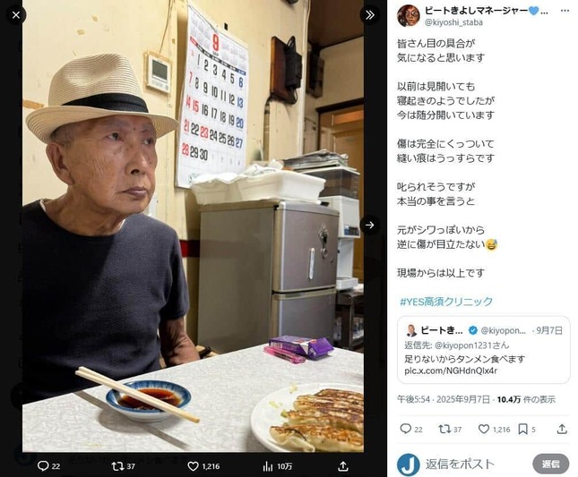 抜糸から1週間後のビートきよしさん、マネジャーのX（＠kiyoshi_staba）より