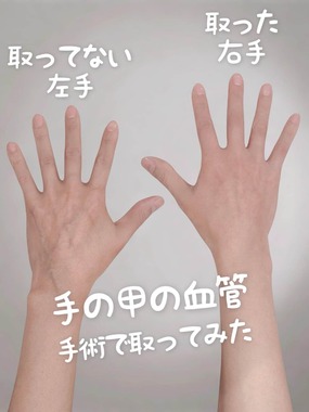 波紋を広げた投稿写真。血管を取った右手と取っていない左を比較。すでに削除されている
