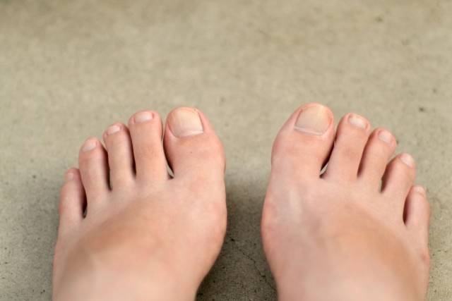 足の爪は両端を短く切らないで　「巻き爪」から歩行困難の恐れ