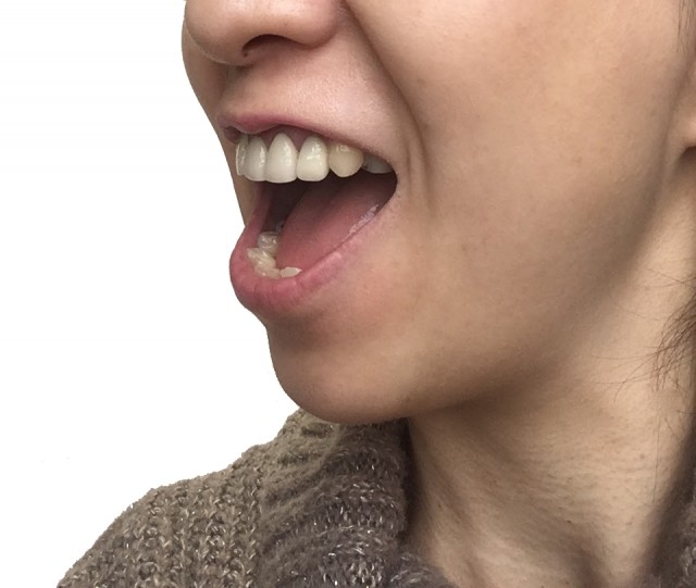 口内炎の原因となるのは、口の中の細菌