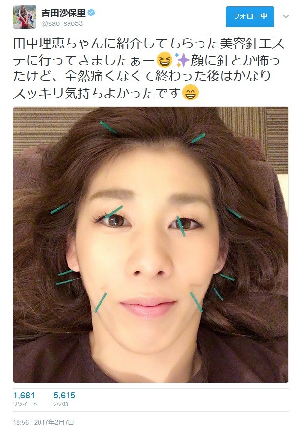 吉田沙保里の女子力アップが加速　「美容鍼灸」でハリまみれ顔を公開