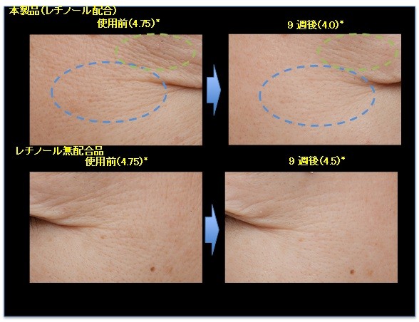 資生堂が「しわを改善する効能効果」の承認を日本で初めて取得