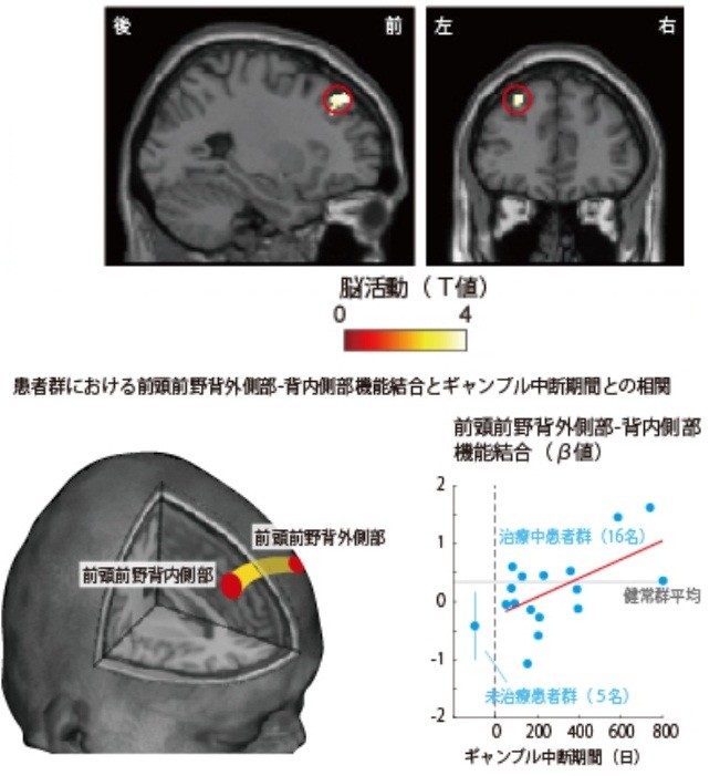 ギャンブル依存症患者、脳がリスクを測れない　京大グループ調査