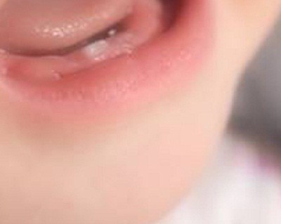 乳歯や親知らずが再生治療の新たな主役か　
