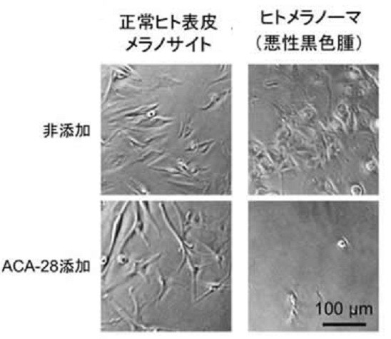 正常なヒト表皮のメラノサイト(左)とメラノーマ細胞。いずれも下が「ACA―28」を添加した状態。メラノーマ細胞の画像では細胞死などが引き起こされたことが分かる
