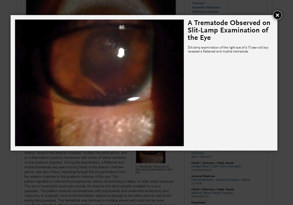 瞳孔の左下に見える白い筋が発見された吸虫（画像は症例報告の資料映像より）
