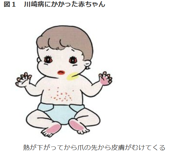 川崎病にかかった赤ちゃんの特徴（国立循環器病研究センターのウェブサイトより）