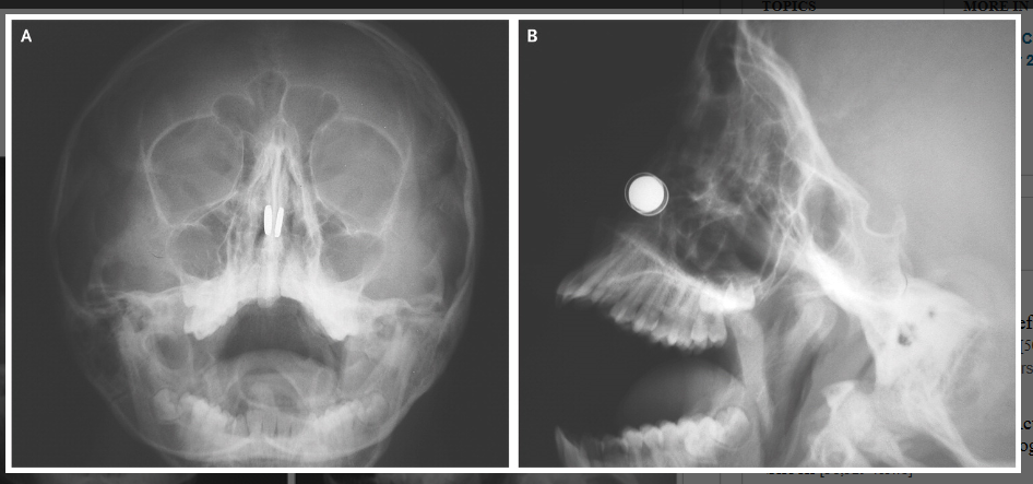 鼻の穴の両側でボタン型磁石（白色の円形）がくっ付いたレントゲン写真。Aは正面、Bは側面（「The New England Journal of Medicine」の論文より）