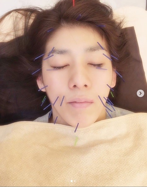 吉田沙保里さんが「美容針」を報告していた（画像は吉田さんインスタより）