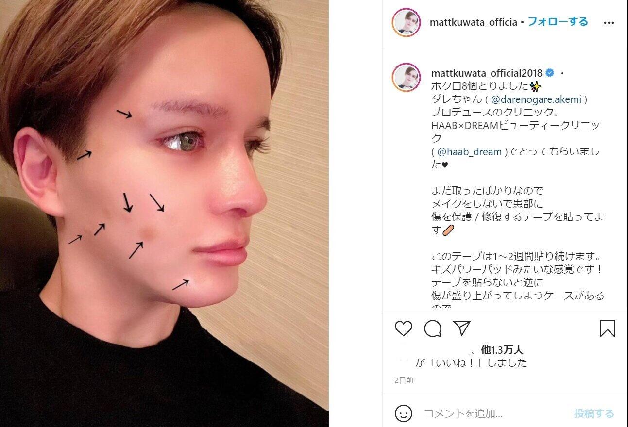 Matt「綺麗なるの楽しみぃ」　「ホクロ8個とりました」のその後