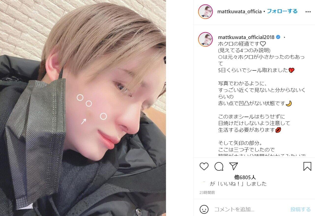 2月17日に施術した後の経過をMattさんが翌日更新のインスタ（@mattkuwata_official2018）で報告した。
