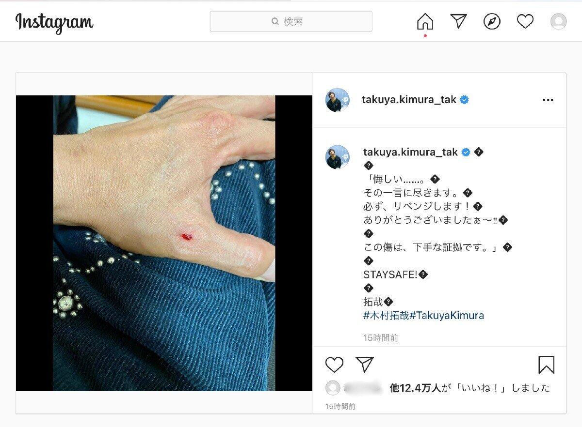 木村さんが投稿した「左手の傷」の写真（木村拓哉さんのインスタグラムより）