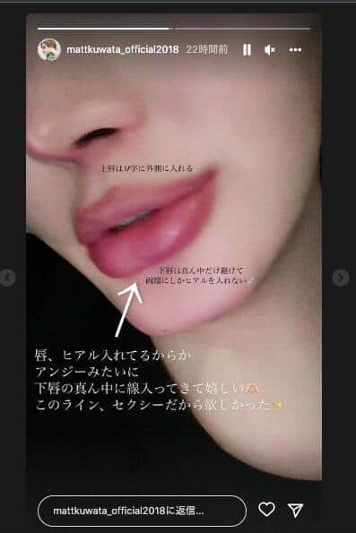 ヒアルロン酸を入れたMattさんの唇（ストーリーズ投稿より）