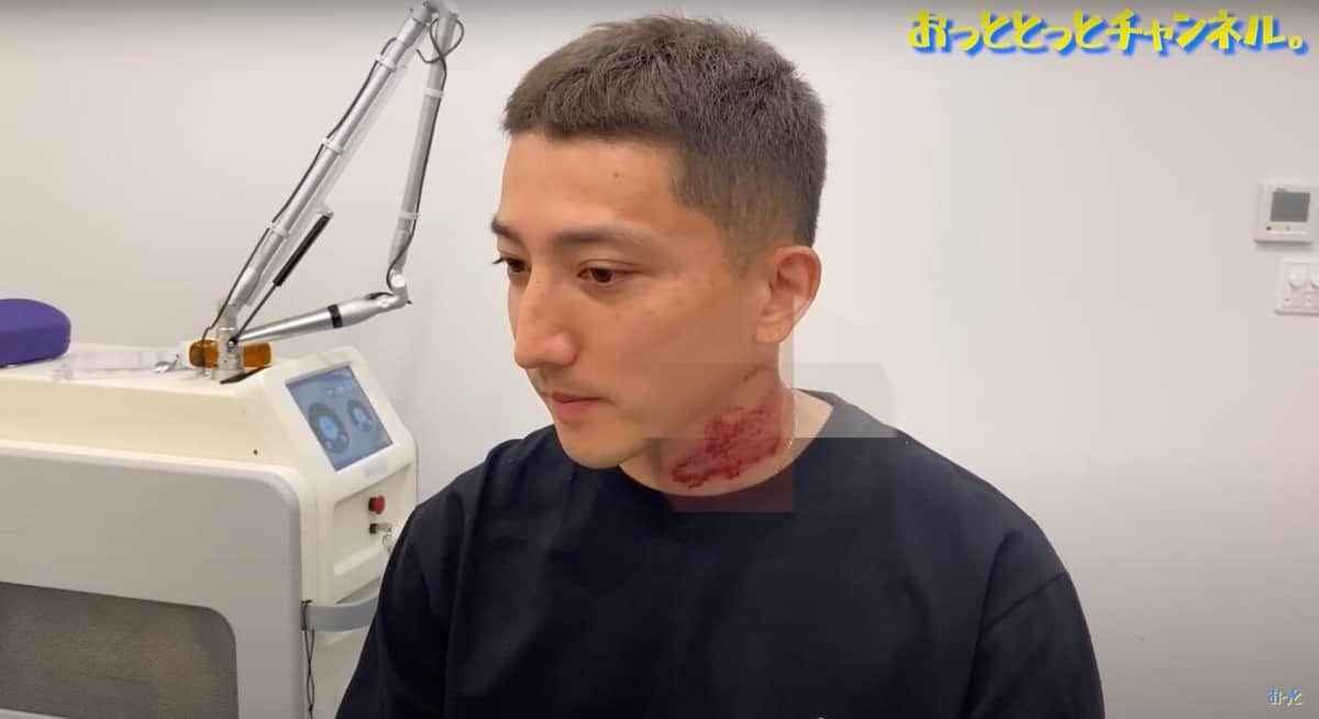 タトゥー除去手術で首が真っ赤になった後藤さん（YouTube動画より）