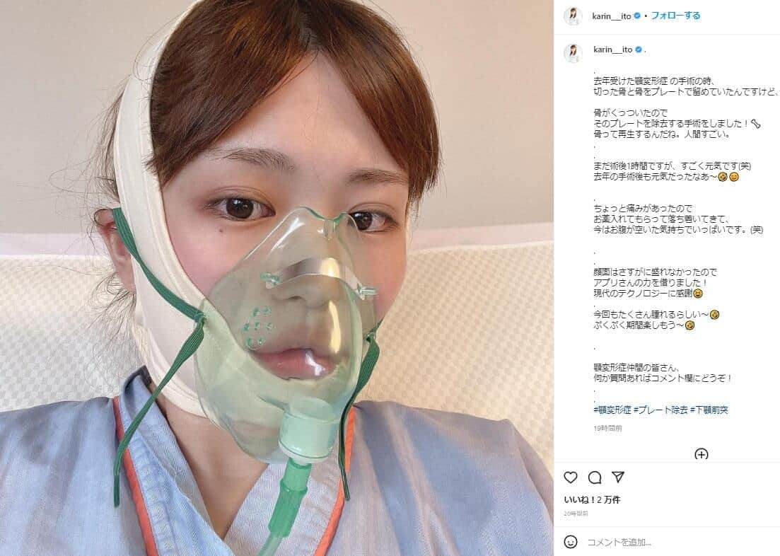 「顎変形症」手術で驚きのビフォーアフター　元乃木坂46がプレート除去を報告「人間すごい」
