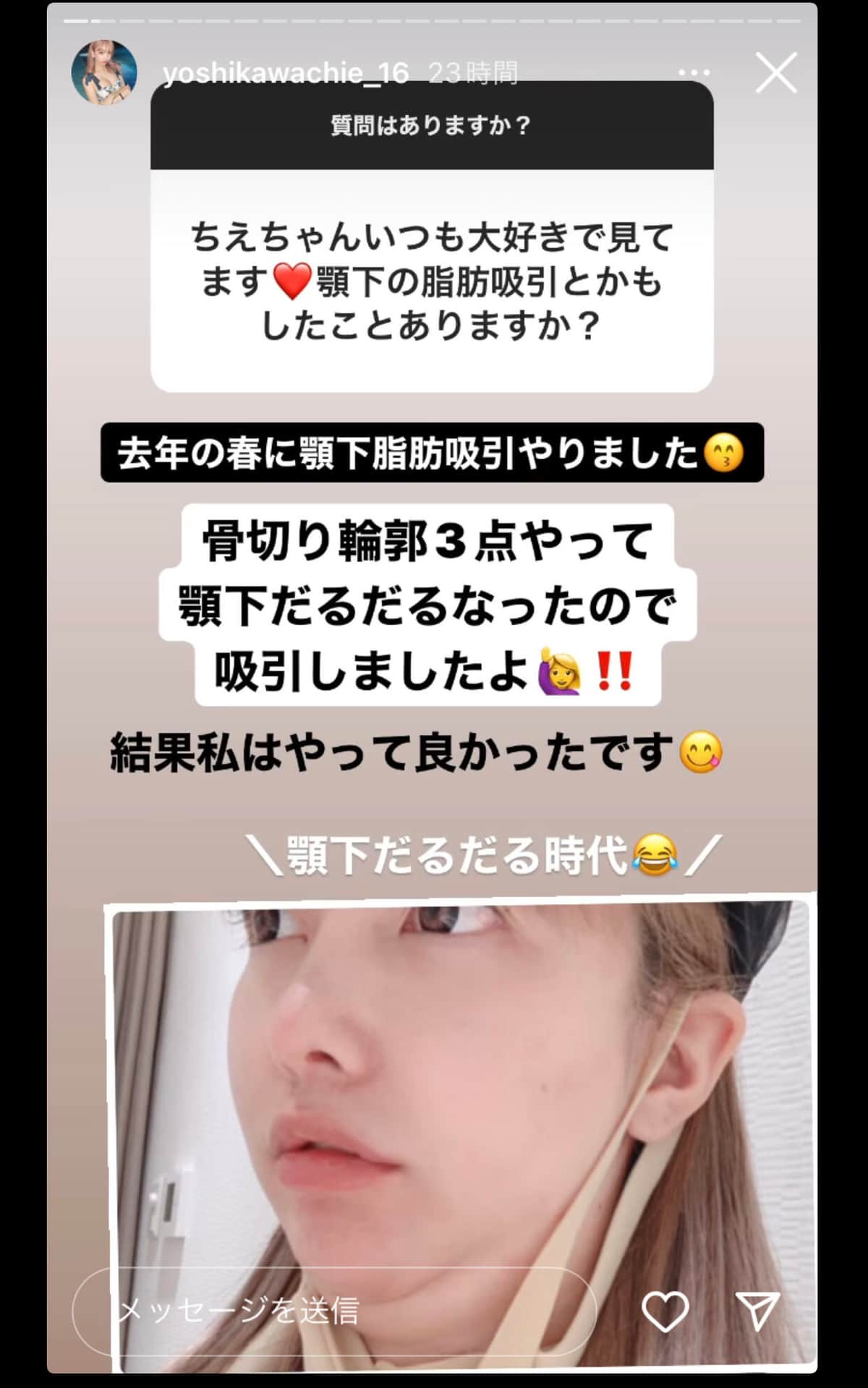 顎下が「だるだる」になった吉川さん（インスタグラムのストーリーズより）