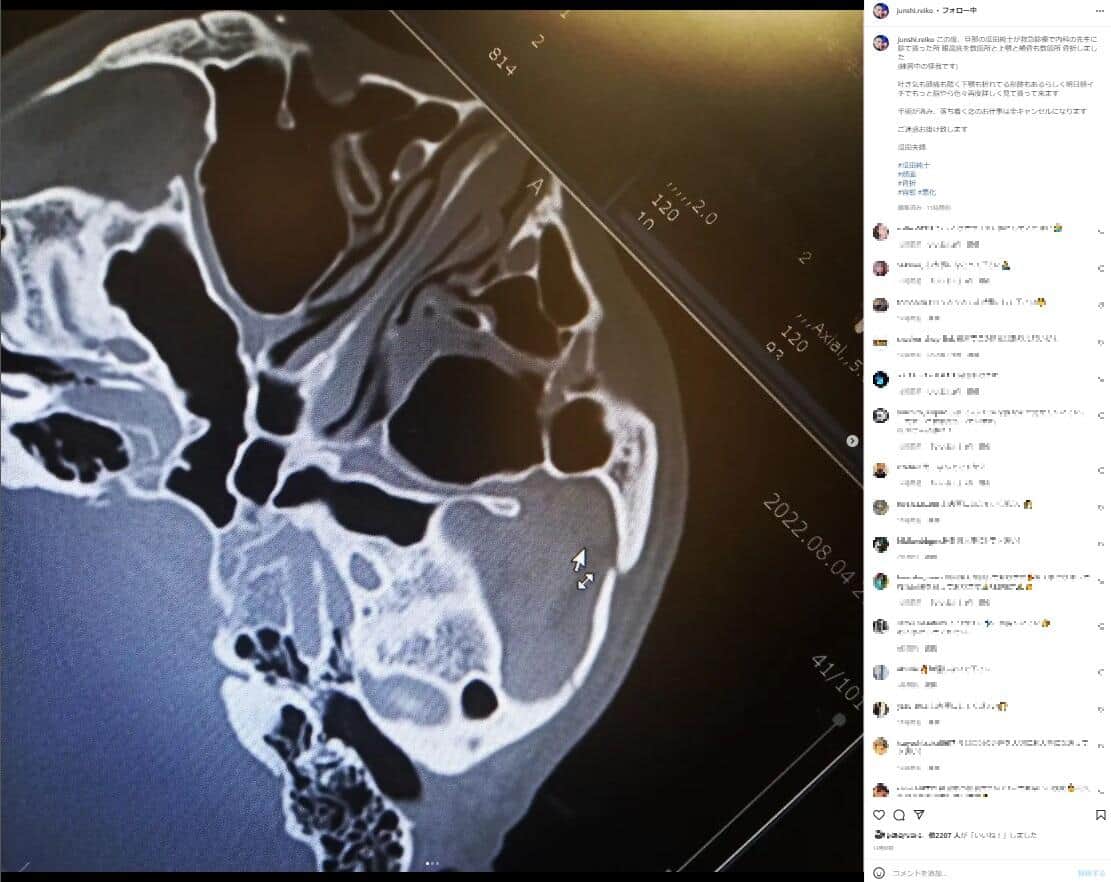 骨折を報告した瓜田純士さん夫婦のインスタグラム（junshi.reiko）より