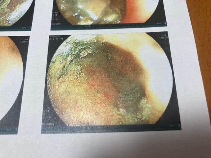 電池のただれた成分が食道に付着（写真は、投稿者の主婦提供）