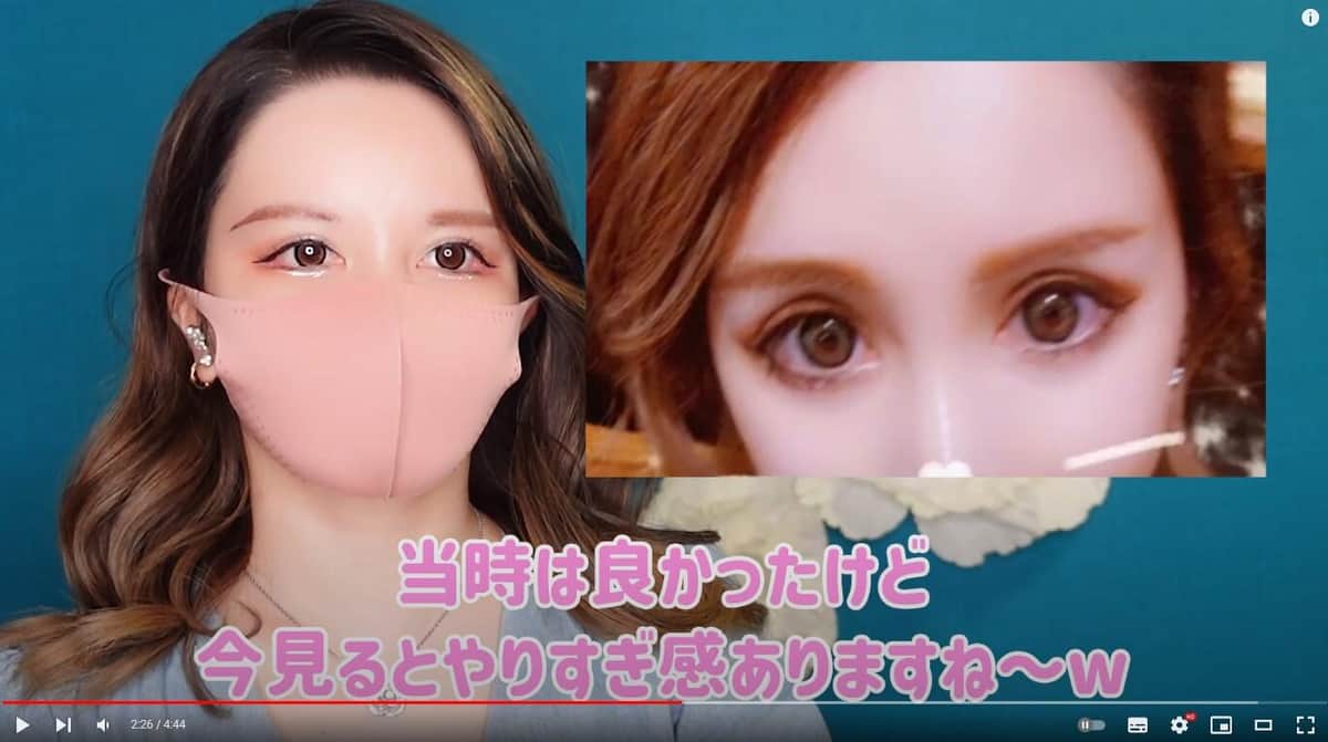 3回目の二重整形後。YouTubeチャンネル「整形3000万円らびちゃん」より