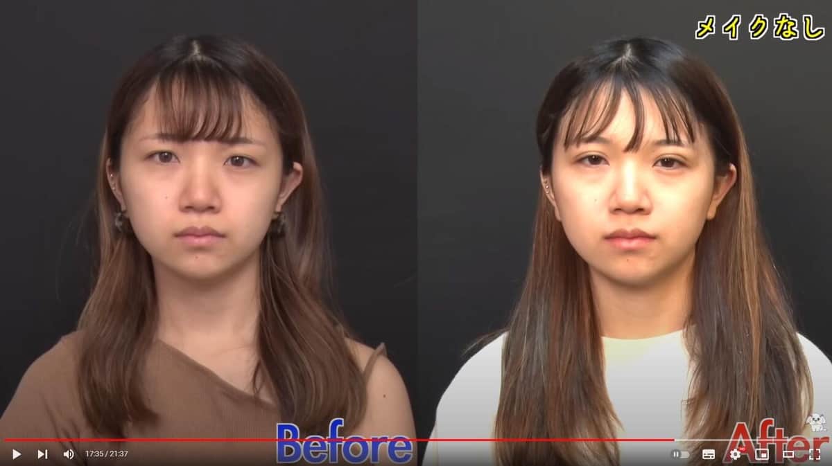 ノエルさんの整形ビフォーアフター。YouTubeチャンネル「美奈子ファミリーTV」より