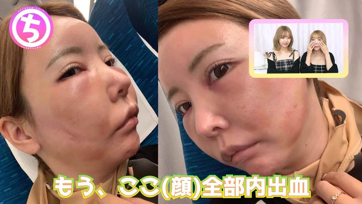 整形手術のダウンタイム中の写真を公開した吉川ちかさん。YouTubeチャンネル「ちえちかちゃんねる/ぐりぐら」より