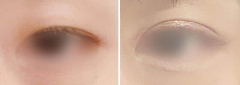 改めて二重整形をしたりのこさん