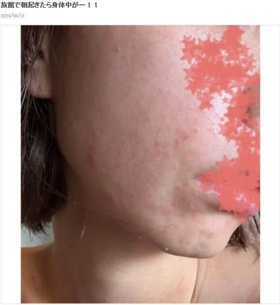 真っ赤になった顔。光上せあらさんのブログより