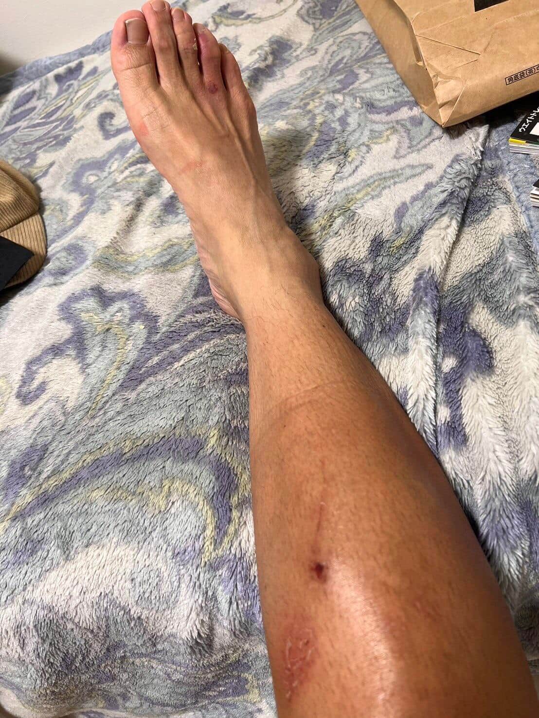 ケガの様子も公開。写真は芳賀セブンさんのポストから