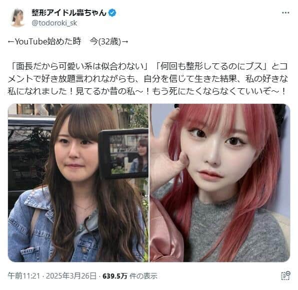 整形総額1300万円超、32歳YouTuberが今昔比較　アンチコメに負けず「私の好きな私になれました！」