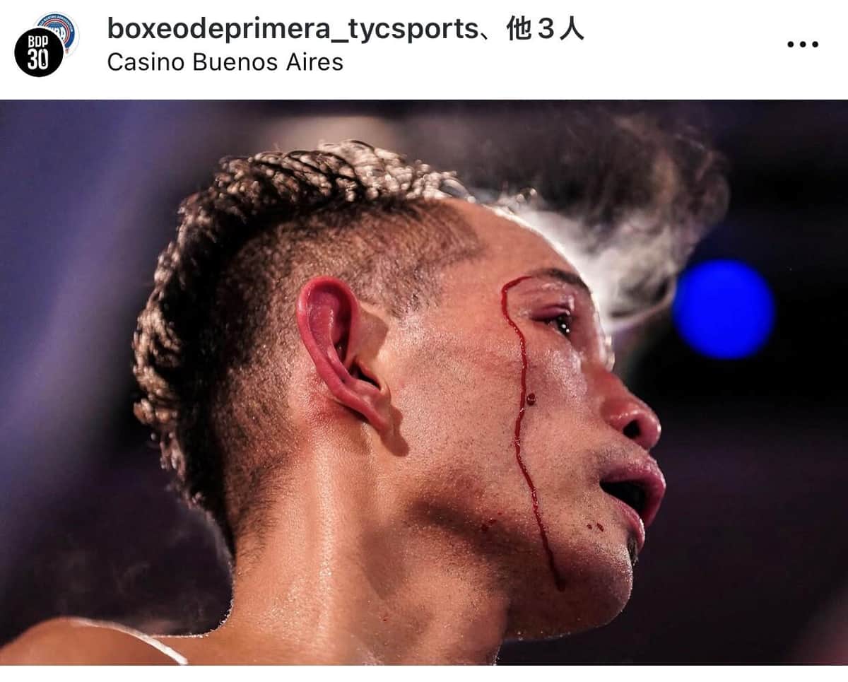 左目上を負傷したドネア（本人インスタグラムより）