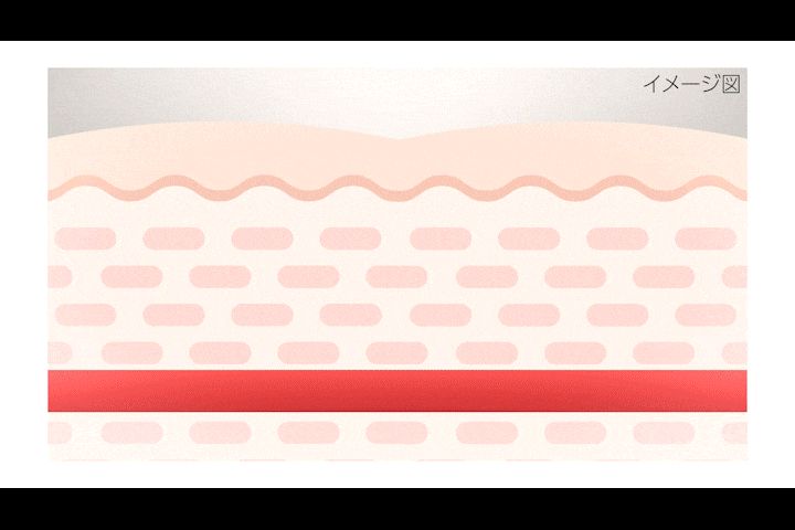 トラネキサム酸は、炎症に関わる物質を誘発するプラスミンを抑える働きがある