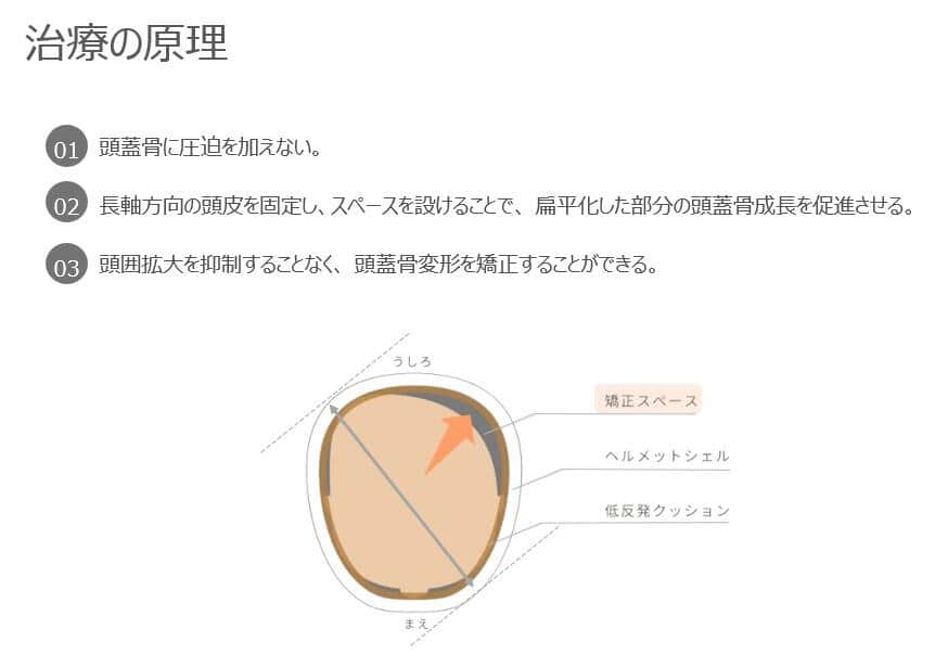 ヘルメット治療の原理（写真提供：坂本好昭氏）