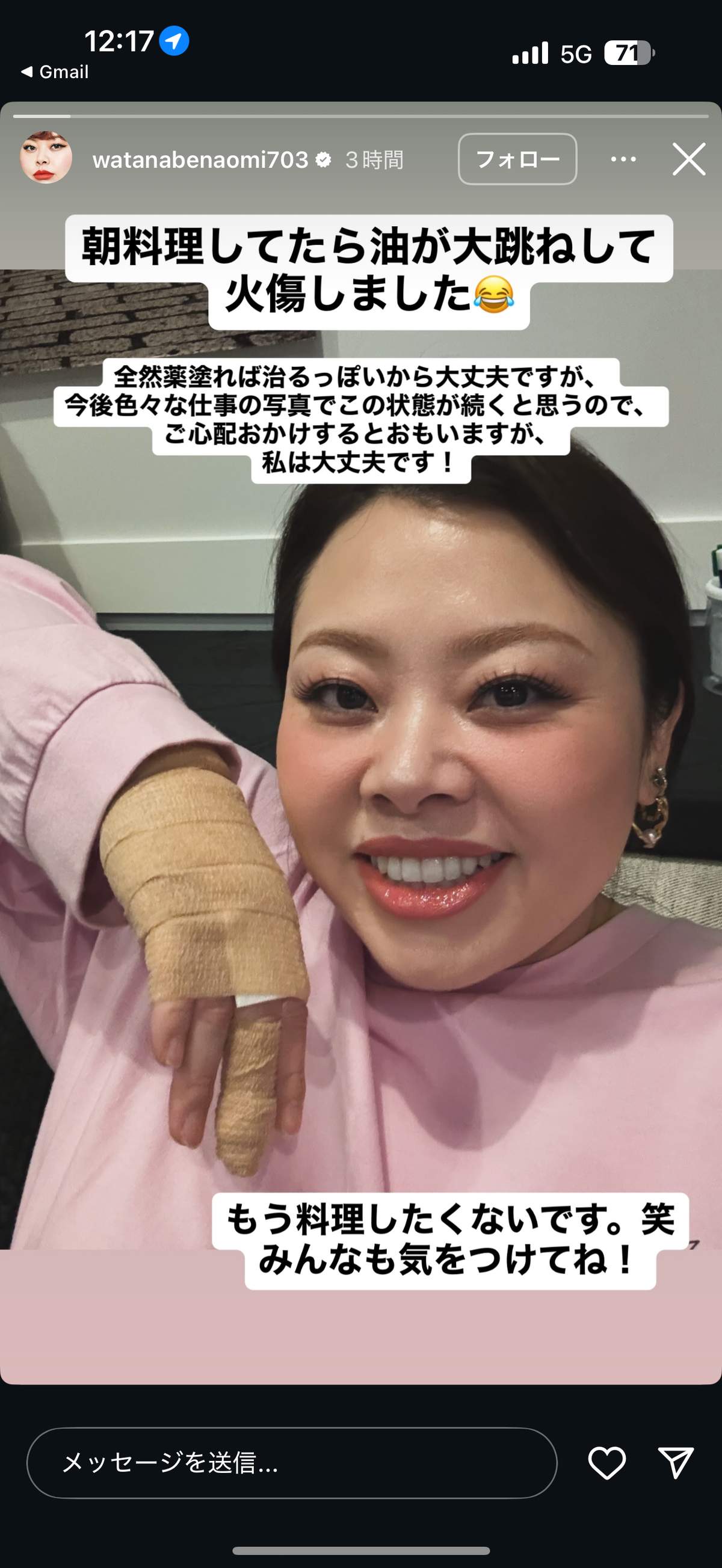 やけどで「もう料理したくないです。笑」と渡辺直美さん。写真は渡辺さんのインスタストーリーズから