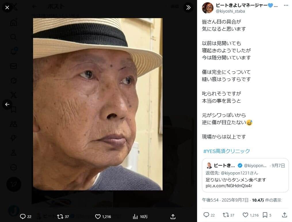 抜糸から1週間後のビートきよしさん、マネジャーのX（＠kiyoshi_staba）より
