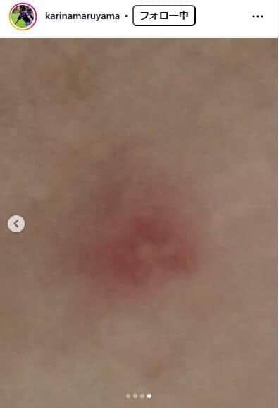 実際の「アーバンマダニ」の噛み跡（丸山桂里奈さんのインスタグラム（＠karinamaruyama）より）
