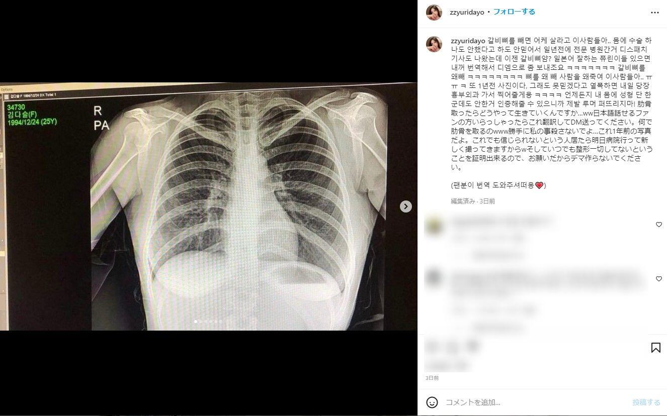 肋骨除去 芸能人
